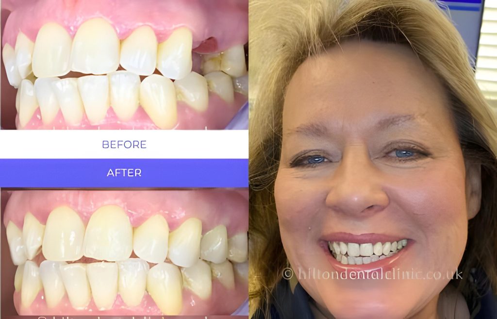Before and after Single tooth implant — Replace a missing tooth
