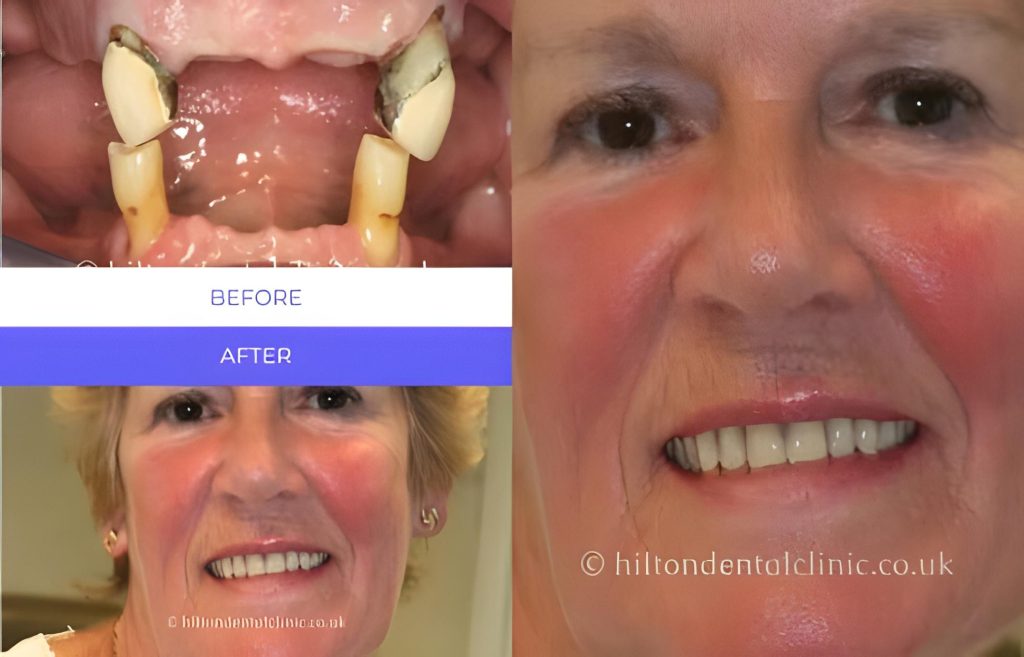 Before and after Implant Supported Overdentures — Full Mouth Restoration