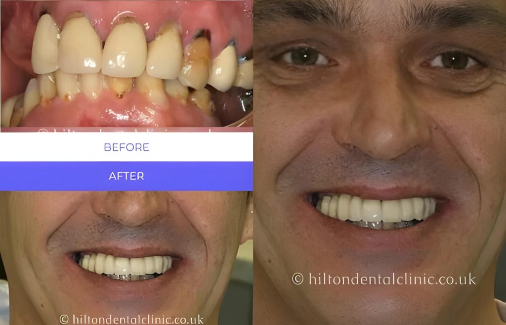 Before and after Full mouth implant supported bridge — Replacing Multiple Teeth