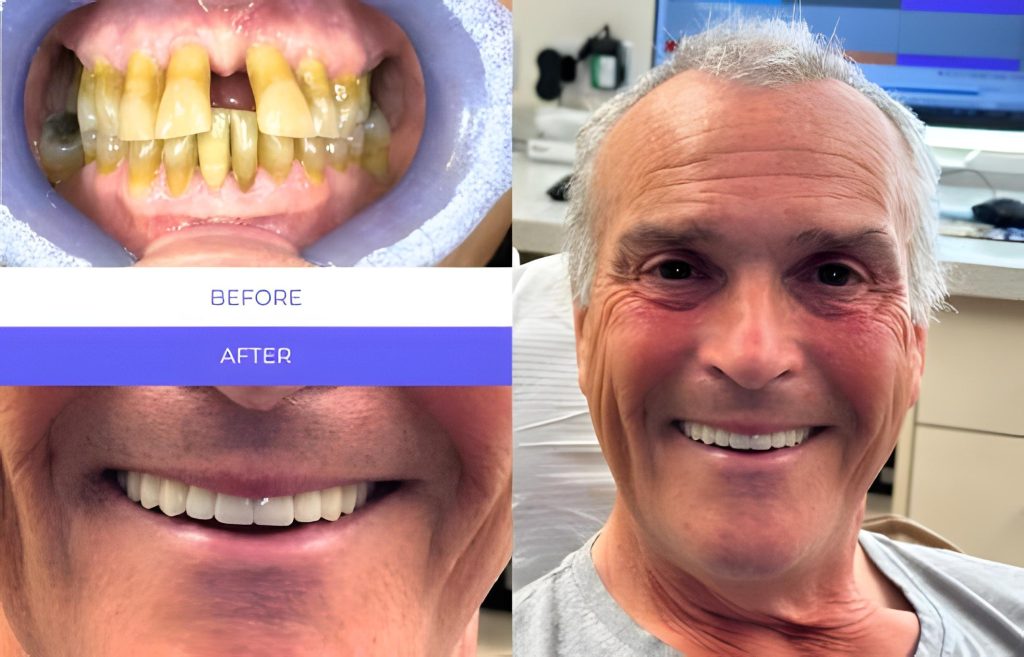 Before and after All-on-4 Dental Implants — Full Mouth Restoration