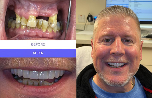 Before and after All-on-4 Dental Implants — Full Mouth Restoration