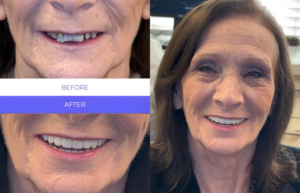 Before and after All-on-6 — Replacing Multiple Teeth